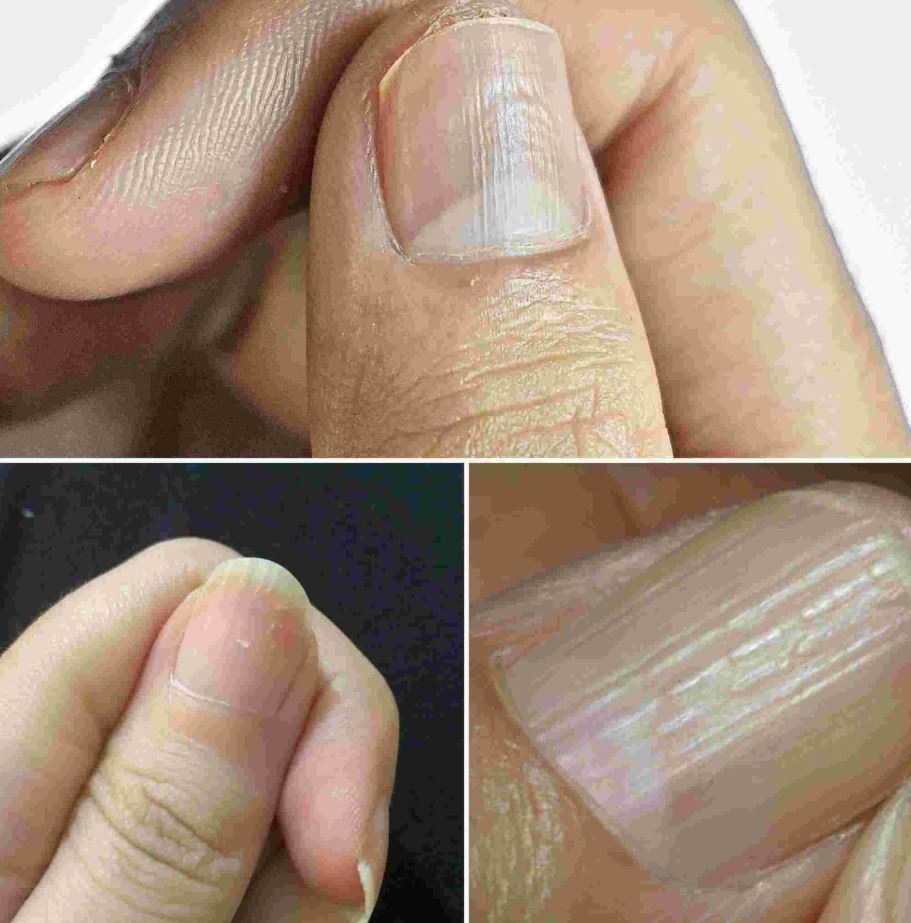 Understanding the Real Causes of Vertical Ridges on Your Nails