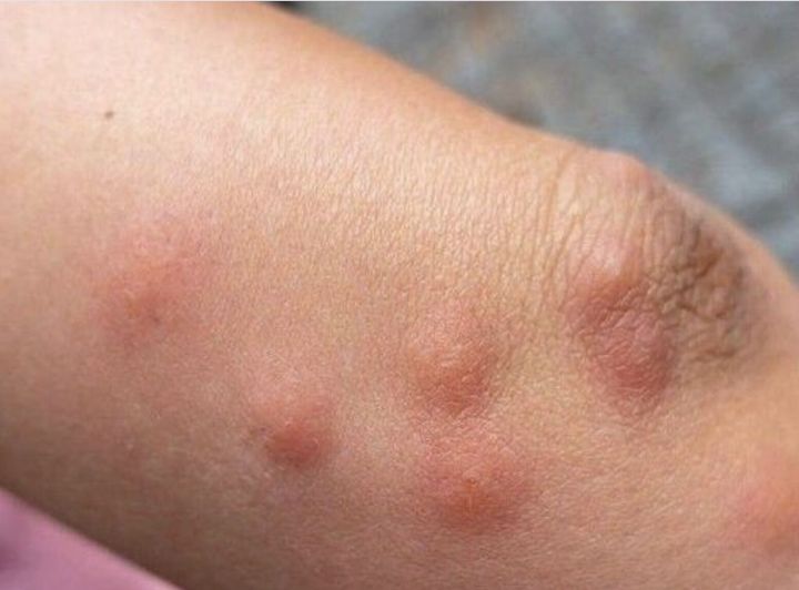 Mosquito Bites: Quick and Easy Relief with a Time-Tested Solution